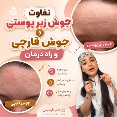 جوش قارچی و زیرپوستی